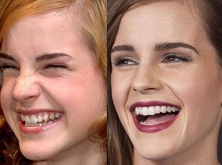 Emma Watson's teeth comparison pictures.