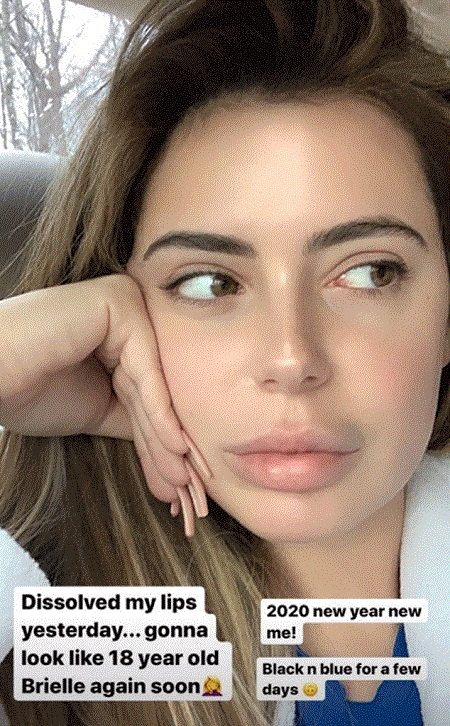 Brielle Biermann's photo from her Instagram story, taking a selfie by declaring she dissolved her lips.