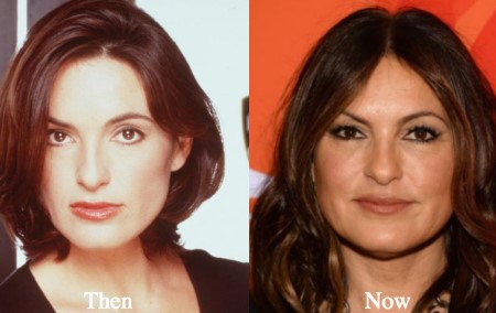 Mariska Hargitay Plastic Surgery.