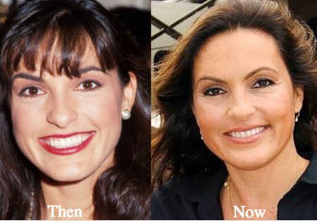 Mariska Hargitay Plastic Surgery.