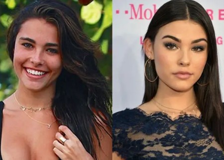 Madison Beer Plastic Surgery.