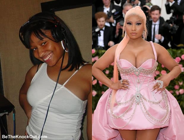 Nicki Minaj's Plastic Surgery: Learn All the Details Here